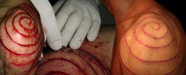 Tatuaje con bisturí