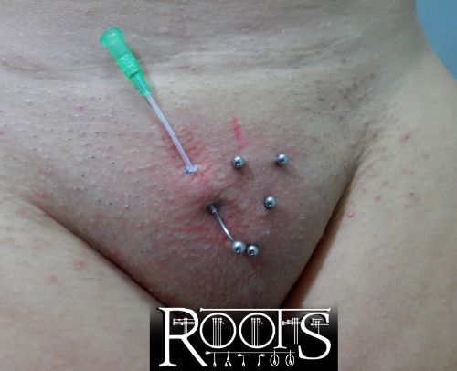 Tres pendientes superficiales sobre vagina